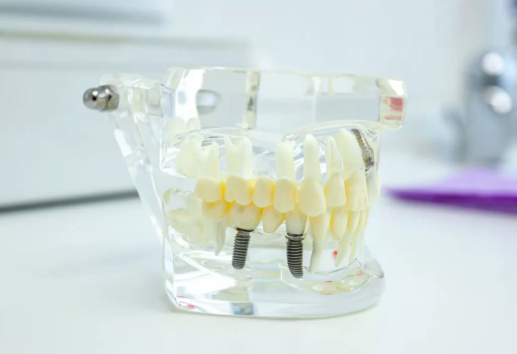 implantes dentales alcalá