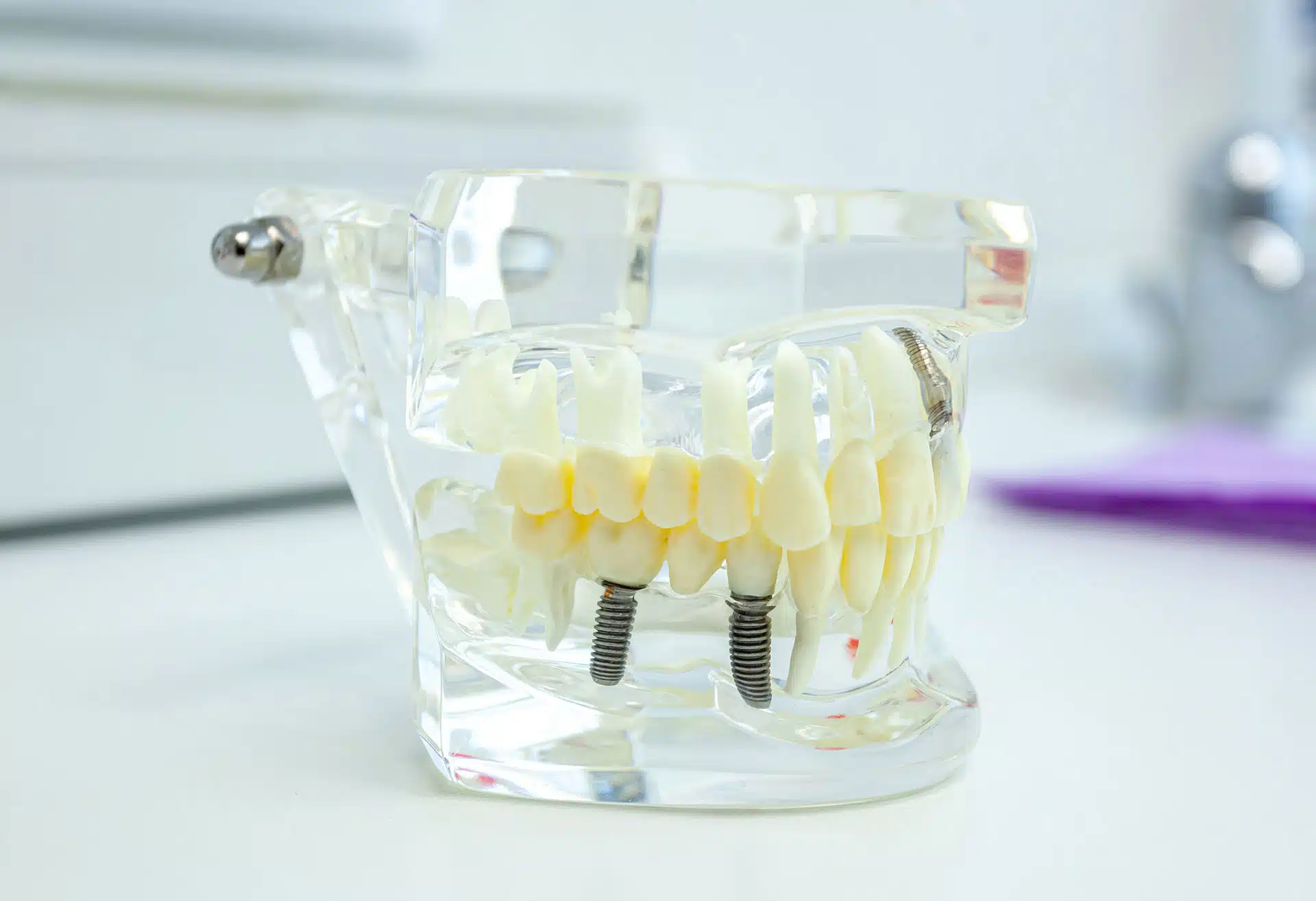 implantes dentales alcalá